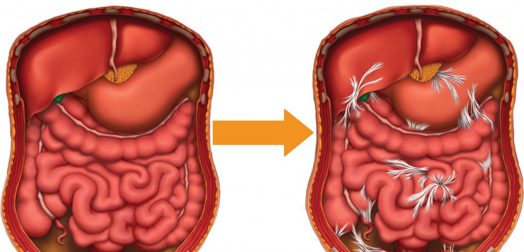 Adhesions-before-after-1024x493-1 Adhesions-before-after-1024x493-1