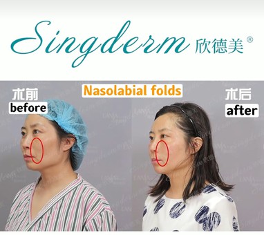 nasolabial folds nasolabial folds