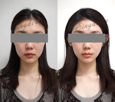 cheek-injection cheek-injection