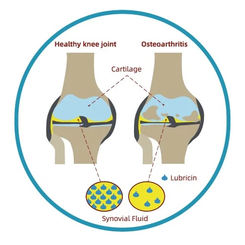 Osteoarthritis Osteoarthritis